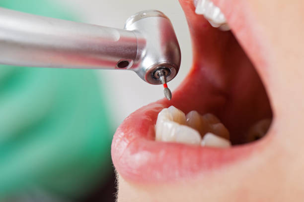 Best Chipped Tooth Repair Near Me  in Charlotte, TN